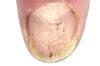 Rỗ móng do Psoriatic JIA gây ra