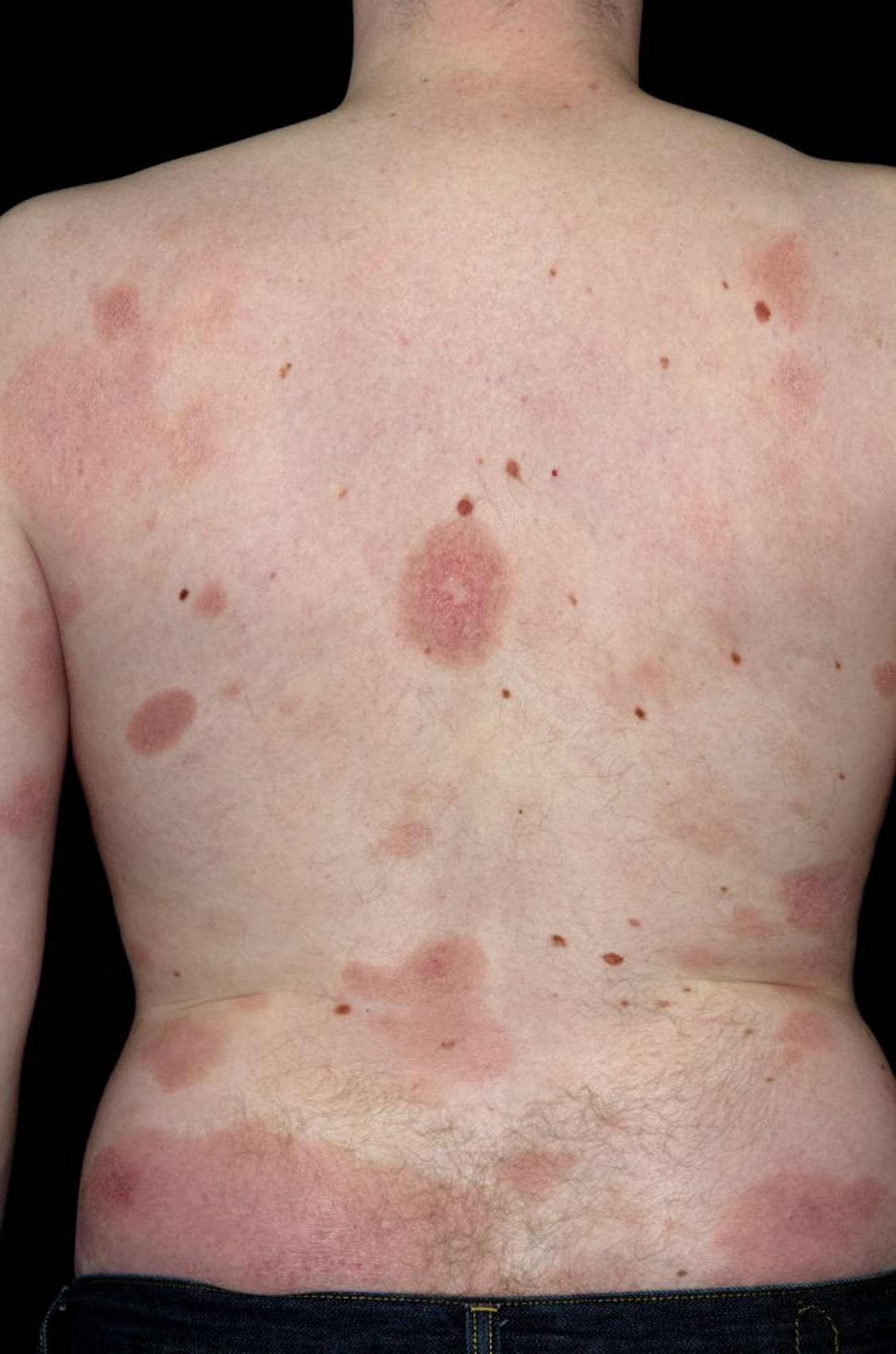 Bệnh nấm Mycosis Fungoides (lưng)