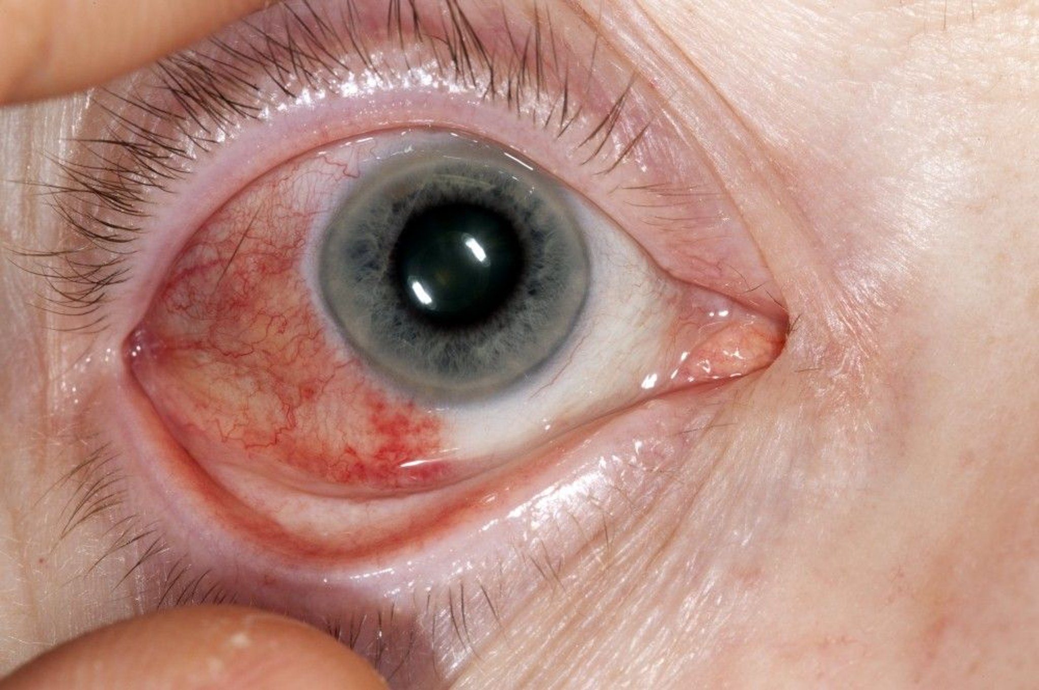 Episcleritis