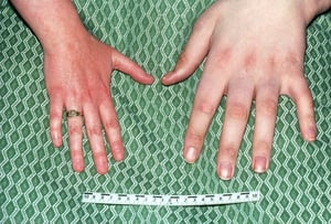 Acromégalie (signes de la main)
