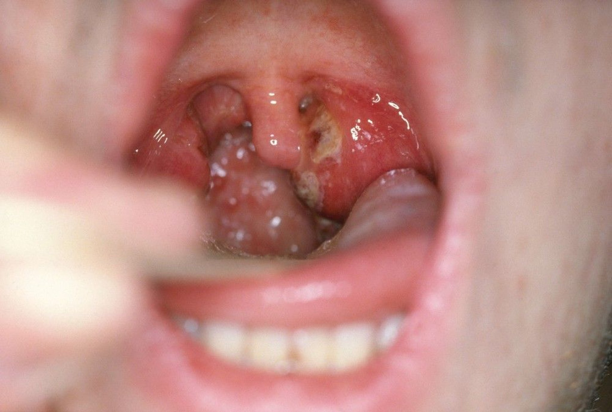 Strep Pharyngitis