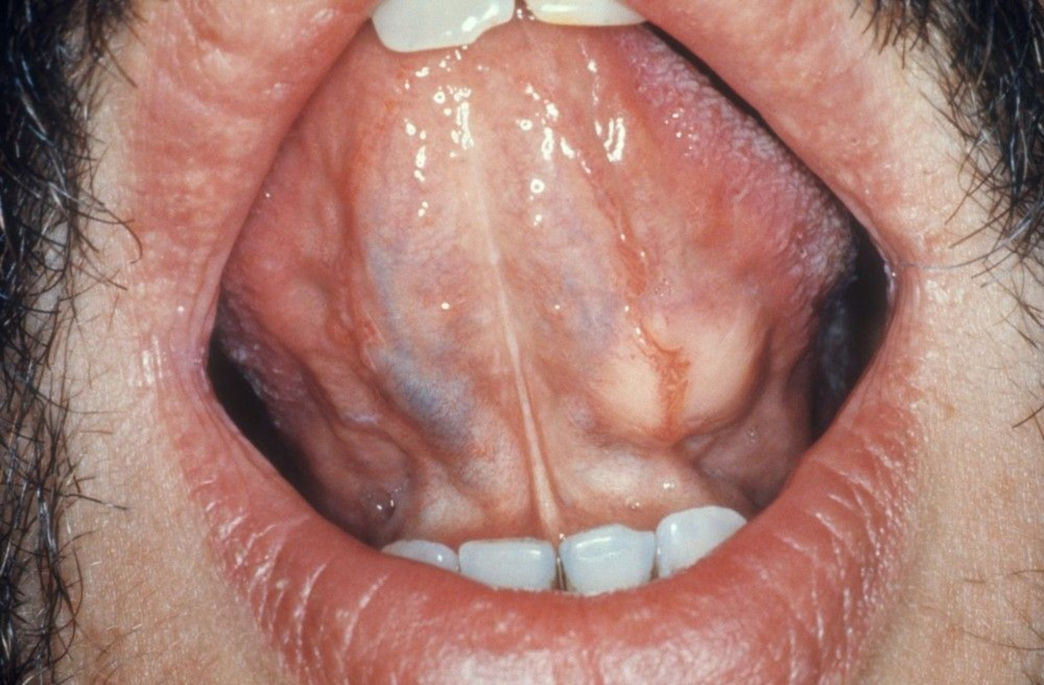 Sublingual Salivary Gland Tumor