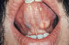 Tumor sublingual de la glándula salival
