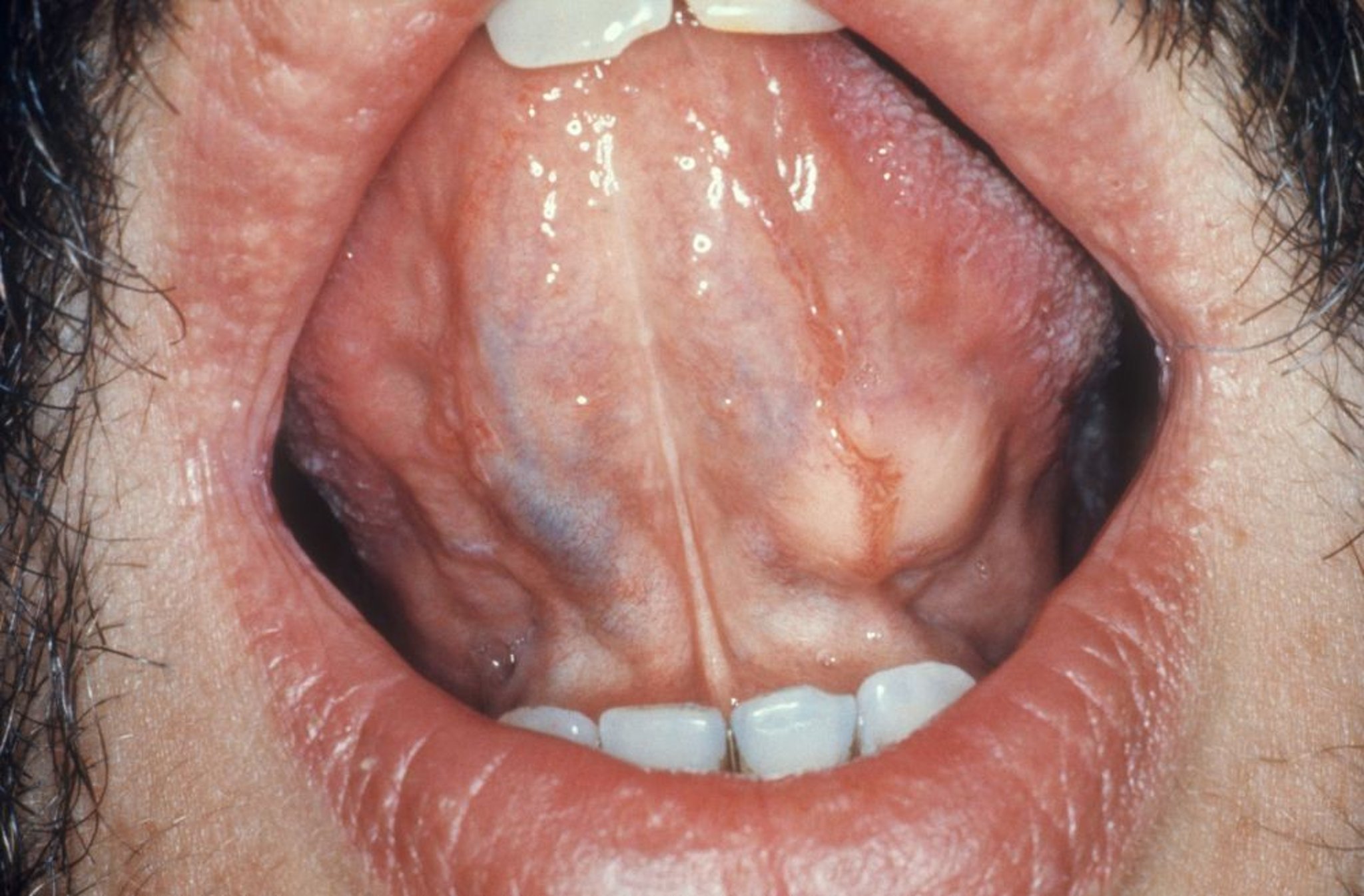 Tumor sublingual de la glándula salival