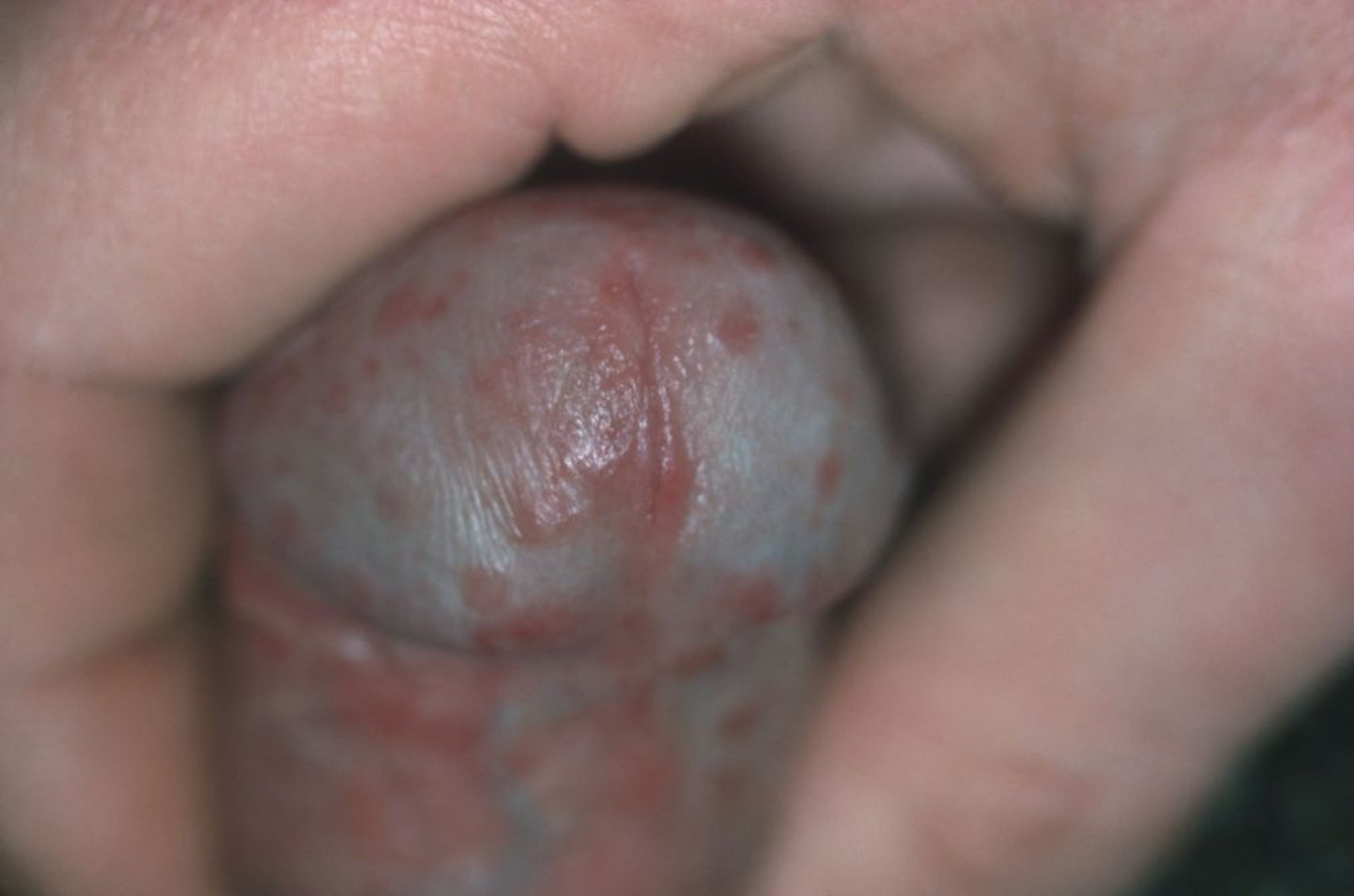Carcinome épidermoïde pénien in situ (anciennement appelé maladie de Bowen)