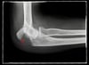 Olecranon Fracture