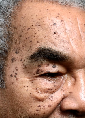 黒色丘疹性皮膚症（dermatosis Papulosa Nigra）
