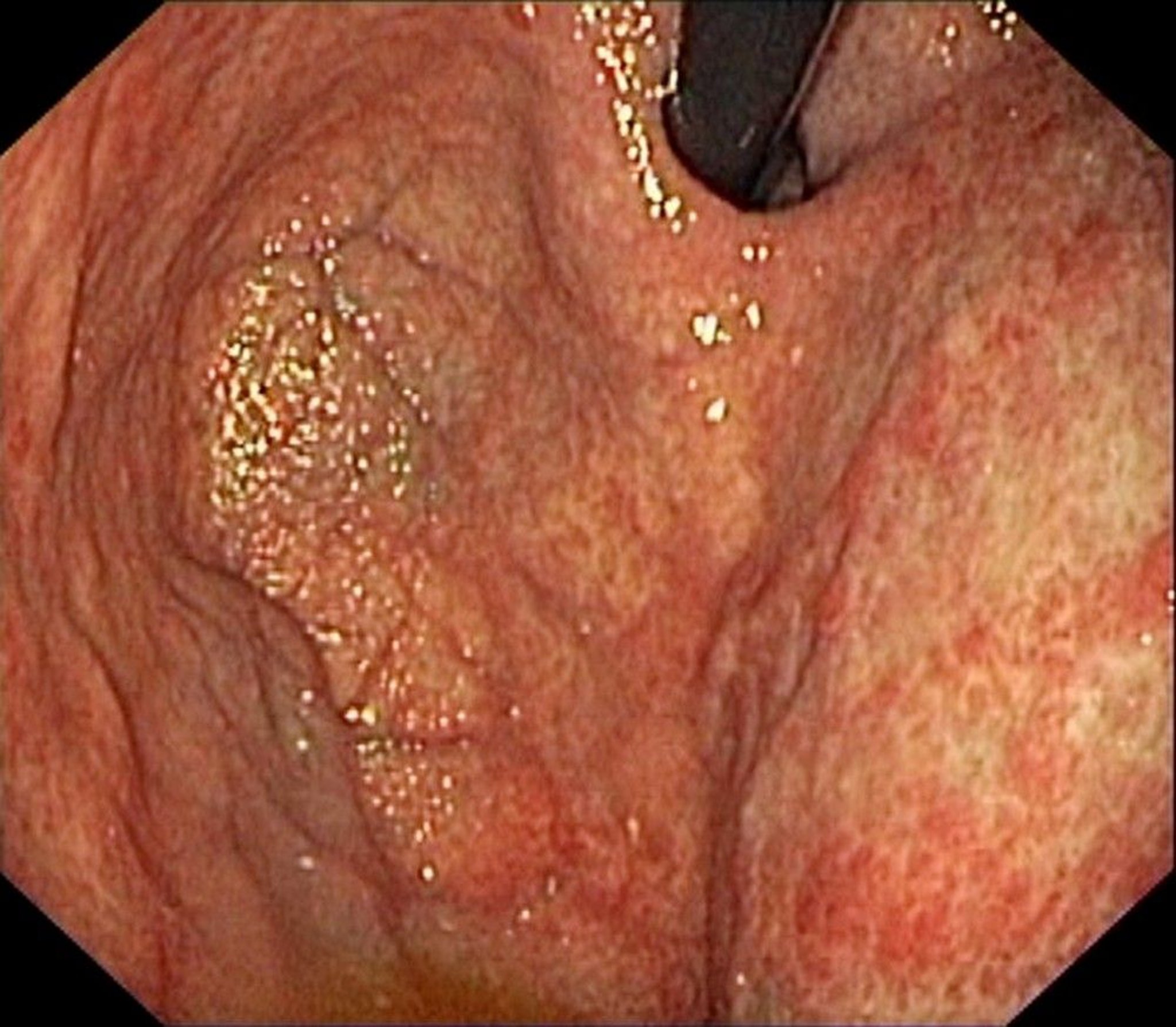 Atrophic Gastritis