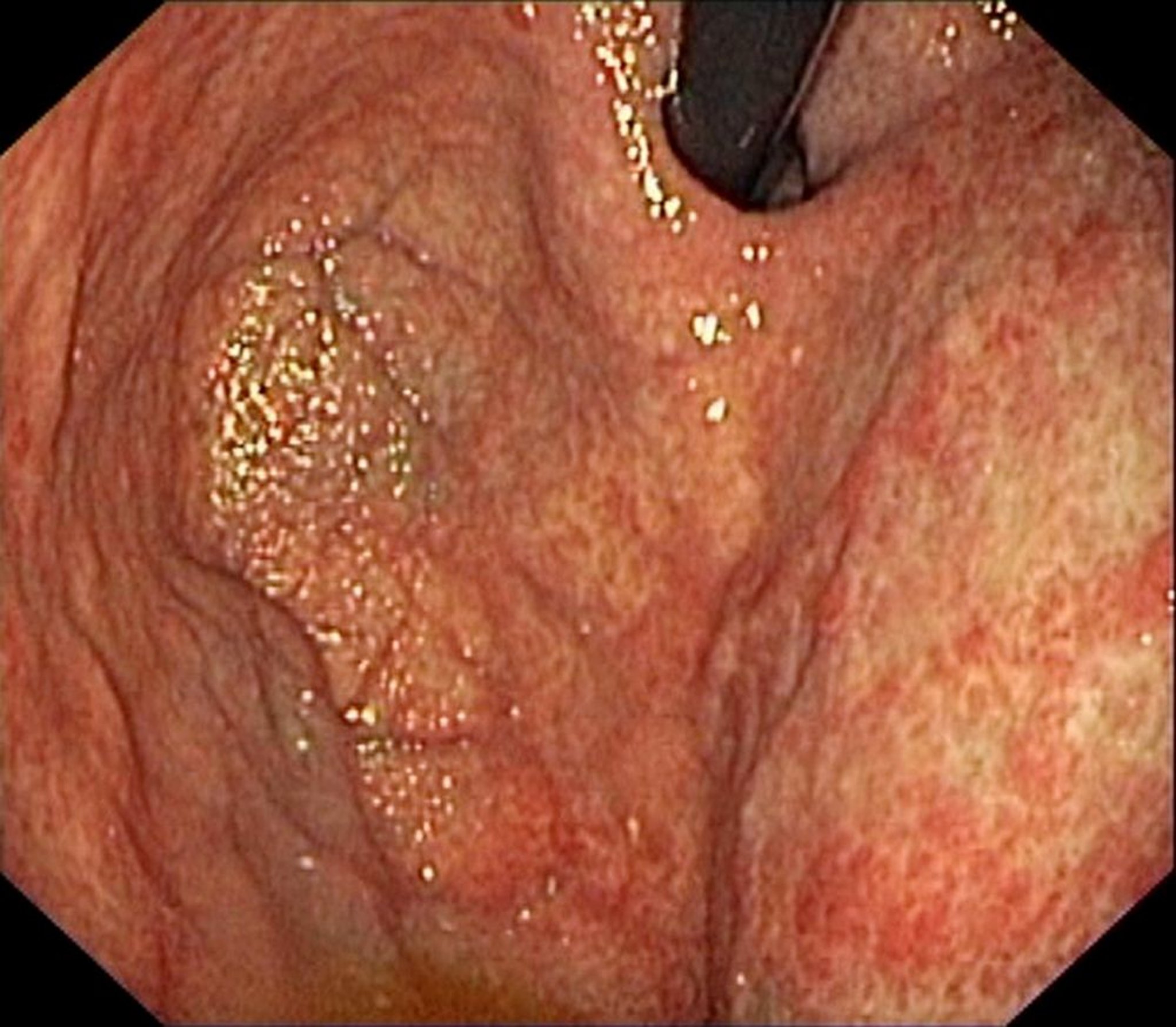 Athropische Gastritis