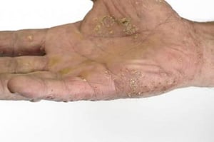 Psoriasis palmoplantaris (Handflächen)