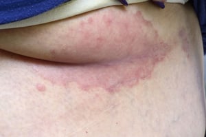 Psoriasis inversa