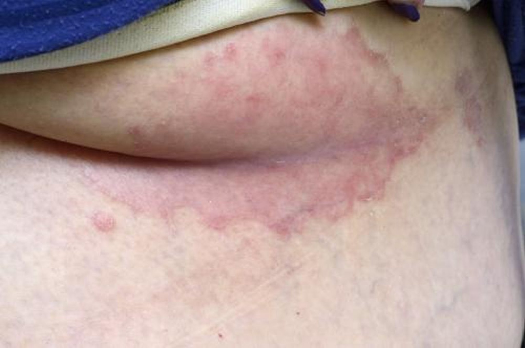 Psoriasis inverse