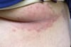 Inverse psoriasis