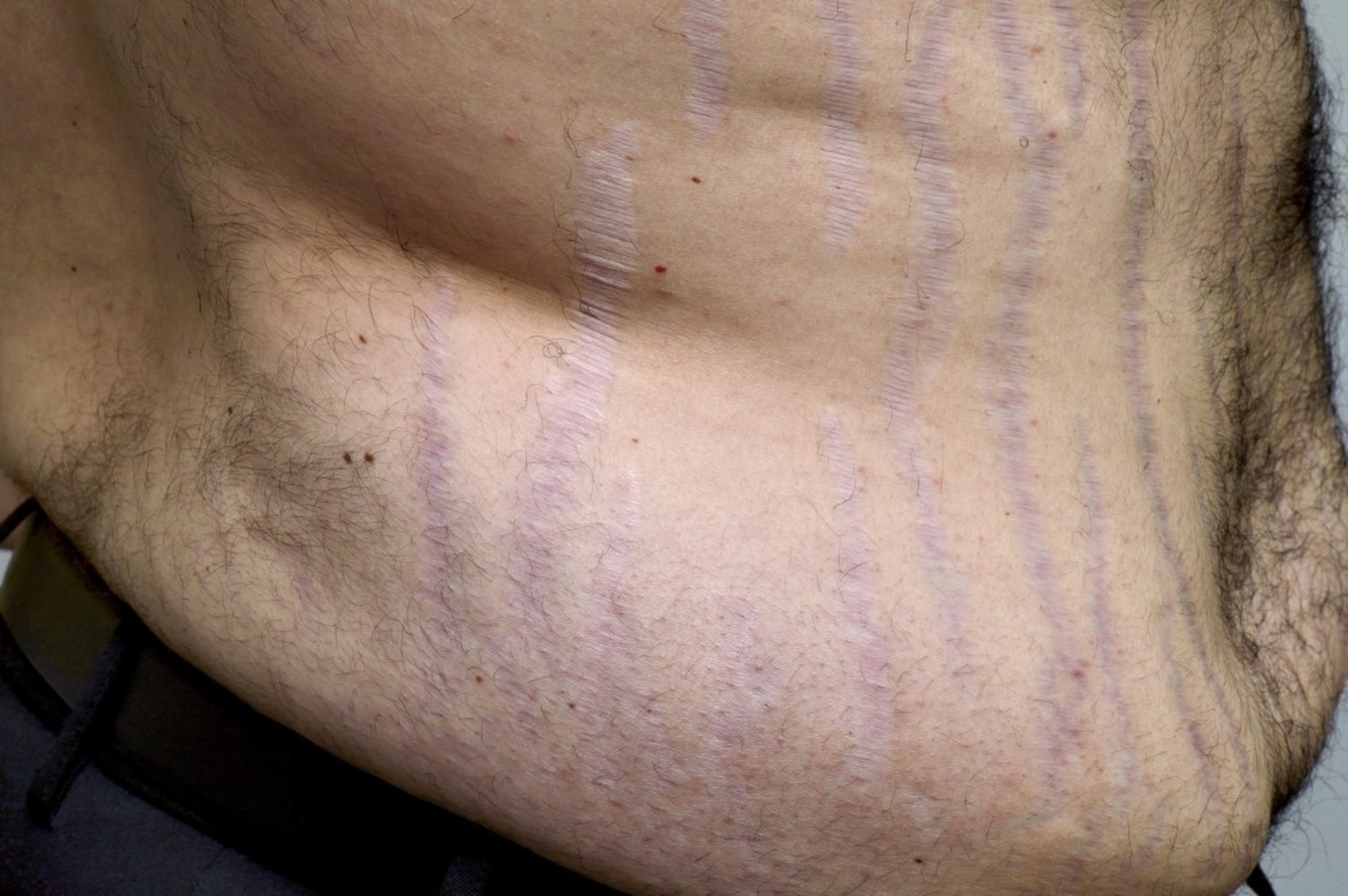 Cushing Syndrome (Striae)