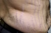 Sindrome di Cushing (strie)