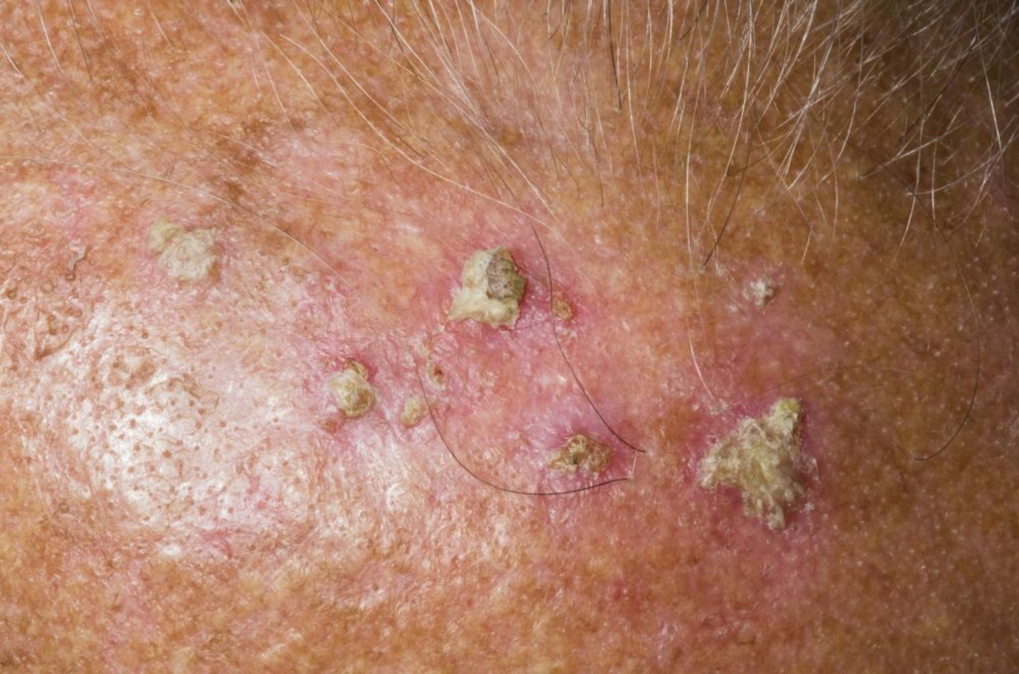 Queratosis actínica (cuero cabelludo)