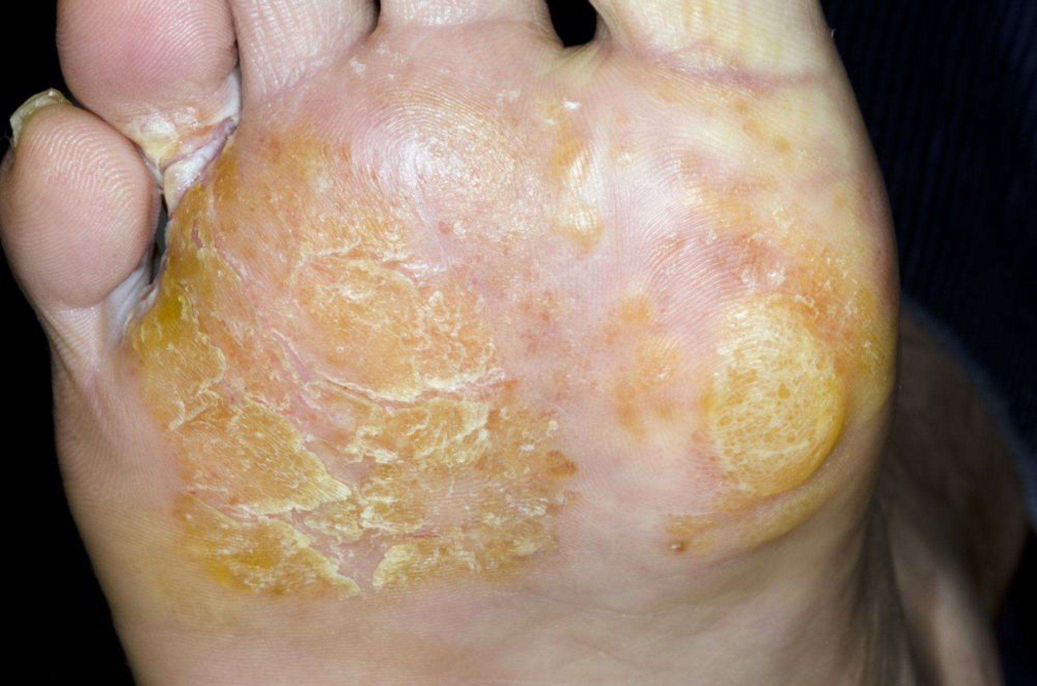 Dermatitis dishidrótica