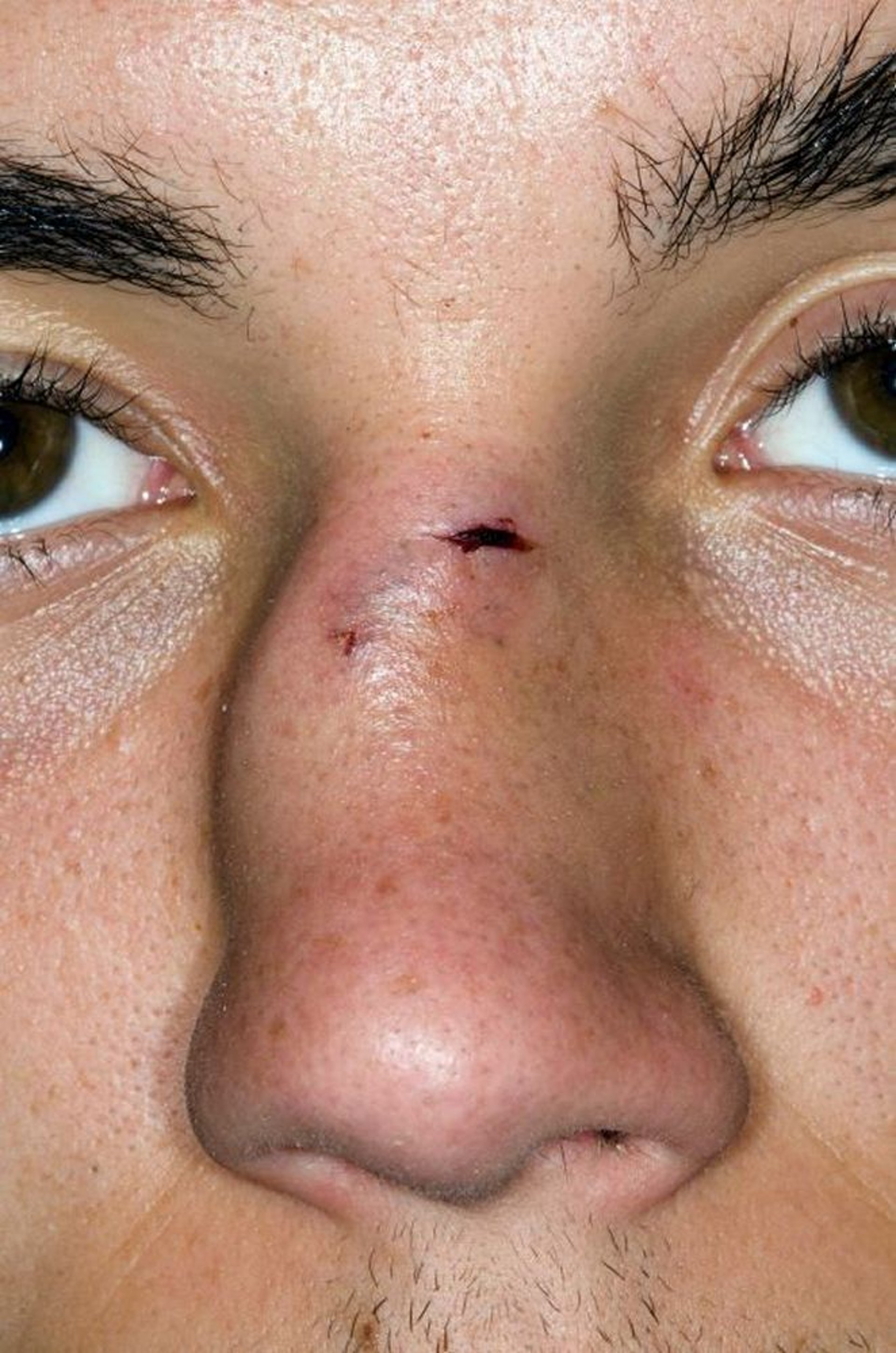 Перелом носа