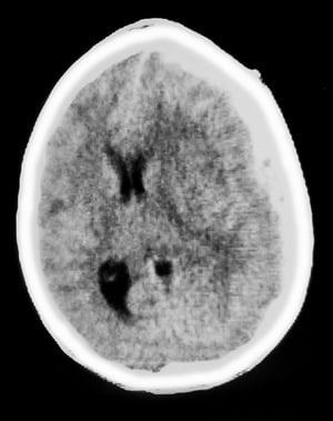 Hematoma subdural