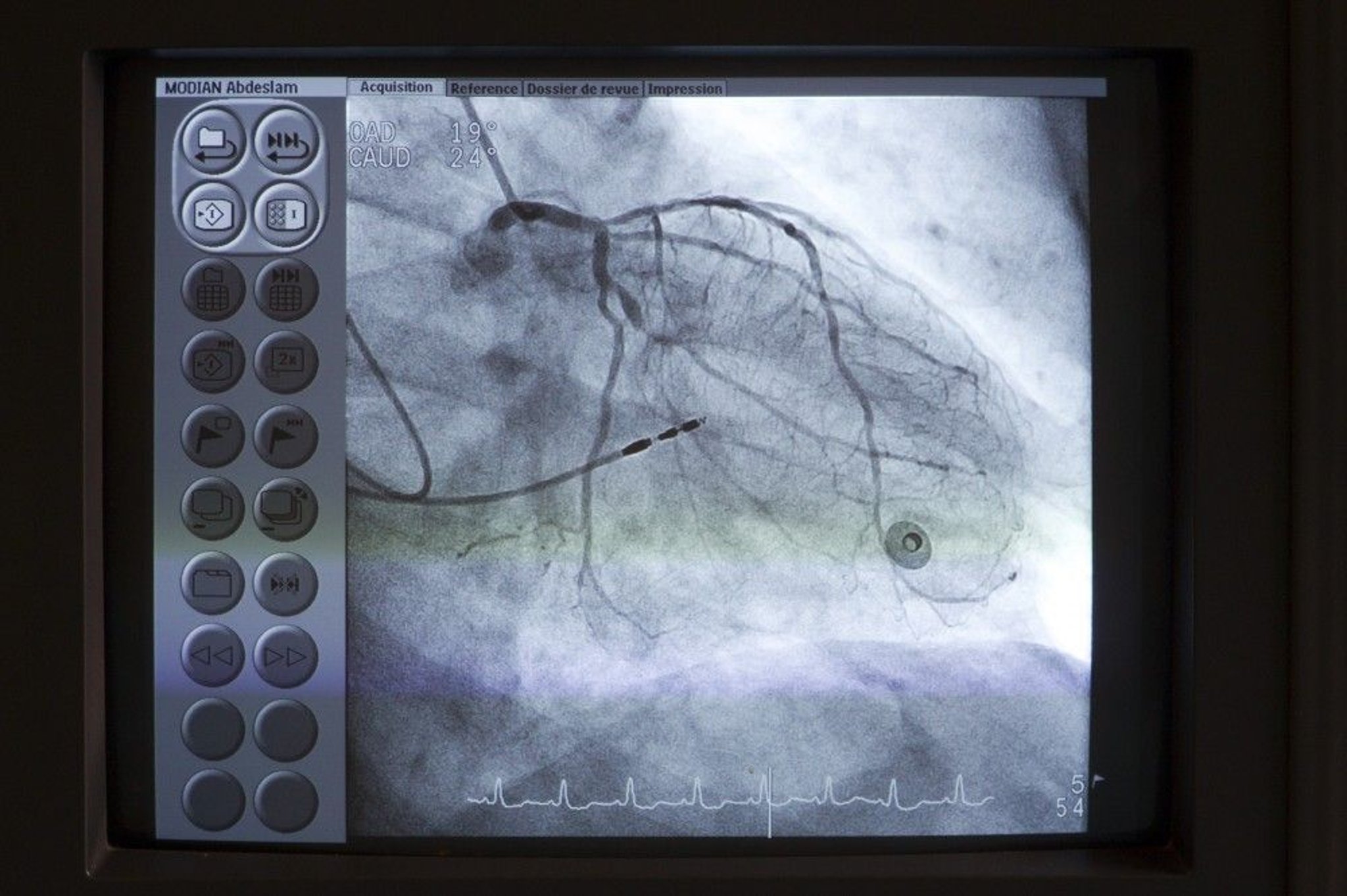 assignment on cardiac catheterization