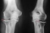 Calcium Pyrophosphate Arthritis (Calcium Pyrophosphate Dihydrate Crystal Deposition Disease, Pyrophosphate Arthropathy, or Pseudogout)