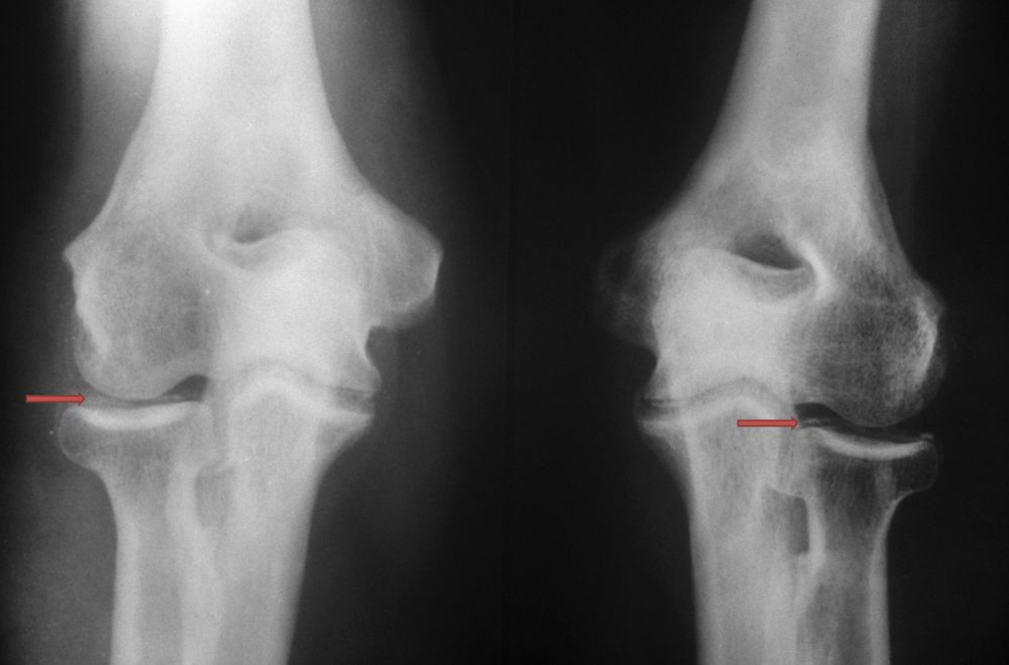 ピロリン酸カルシウム関節炎（ピロリン酸カルシウム結晶沈着症，pyrophosphate arthropathy，偽痛風）
