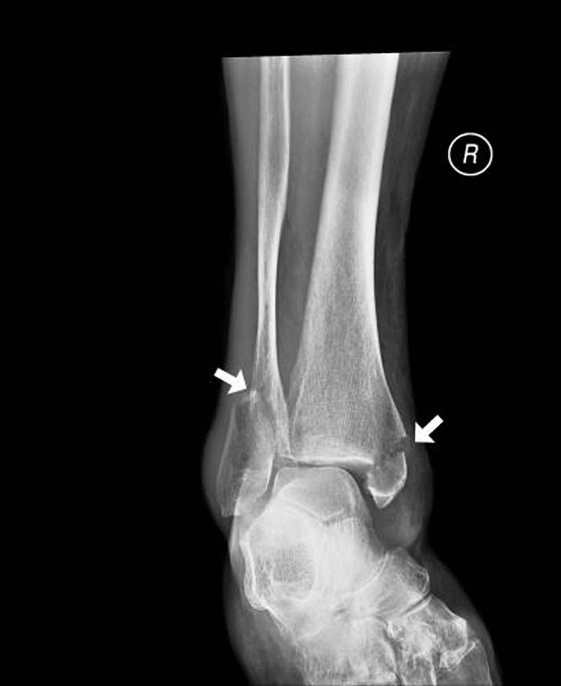 Fractura de tobillo de ambos maléolos