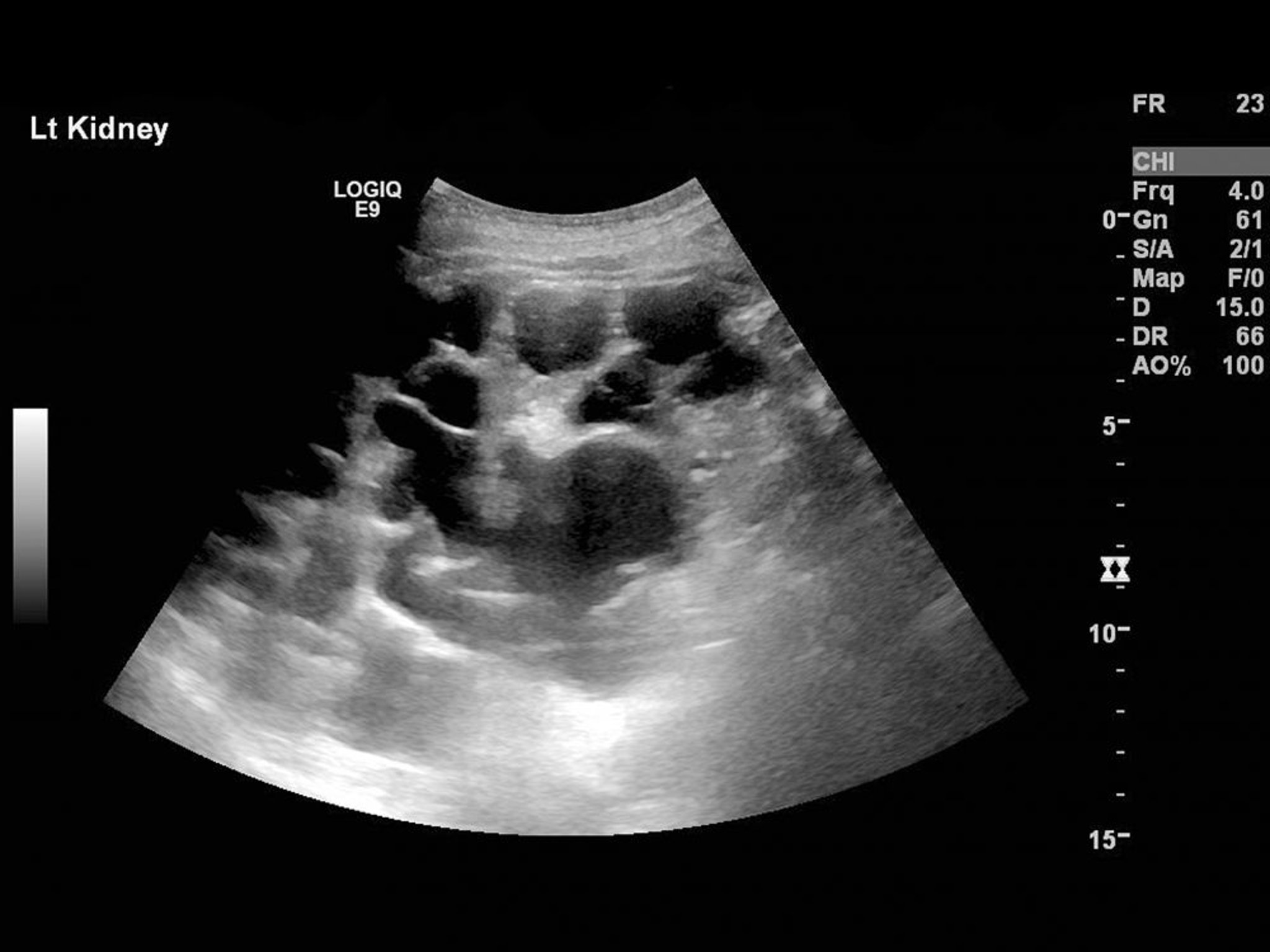 Enfermedad renal poliquística