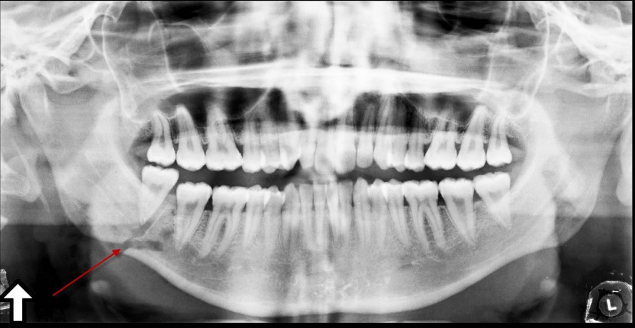 Fracture of the Angle of the Mandible