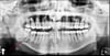Fracture de l'angle de la mandibule