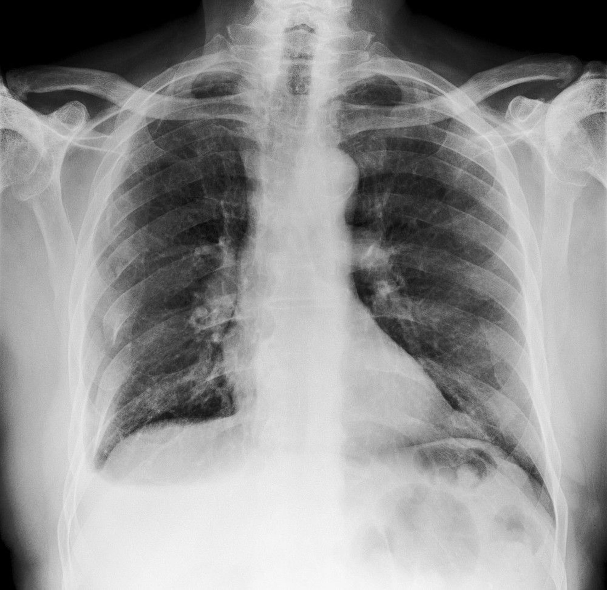 Rib Fractures