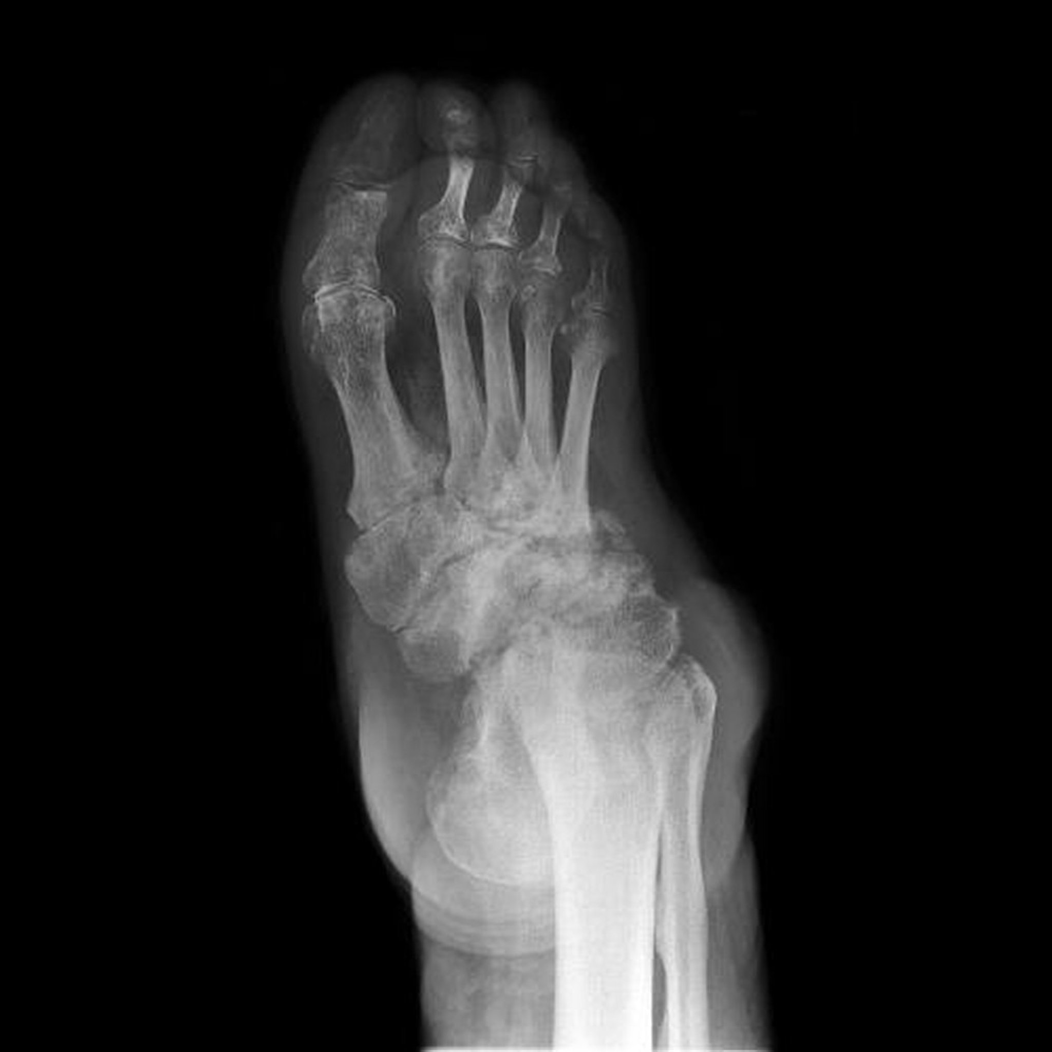 Neuropathic Arthropathy of the Foot