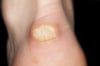Callo (tallone)