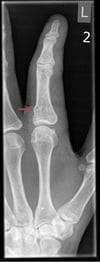 Torus Fracture of the Finger