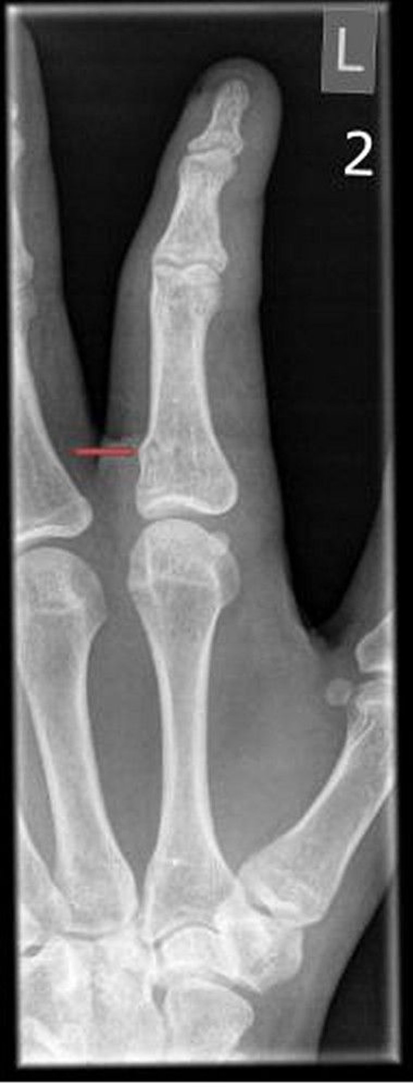 Torus Fracture of the Finger