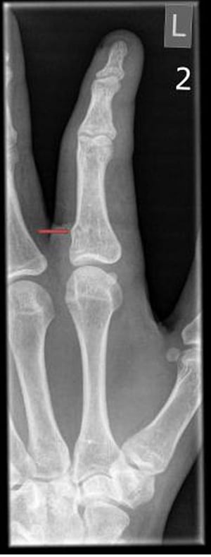 Fractura en rodete (de torus) del dedo