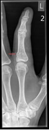 Fracture en tore du doigt
