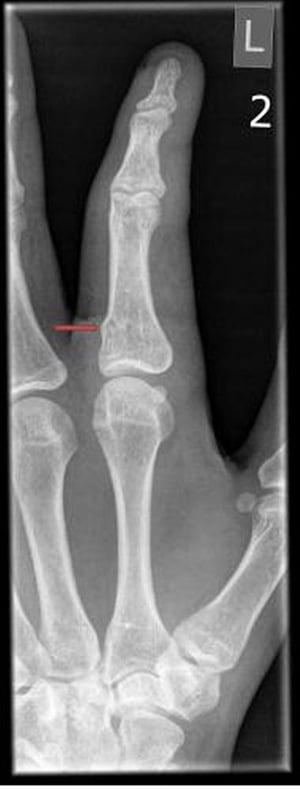 Компрессионный веретенообразный перелом костей пальца