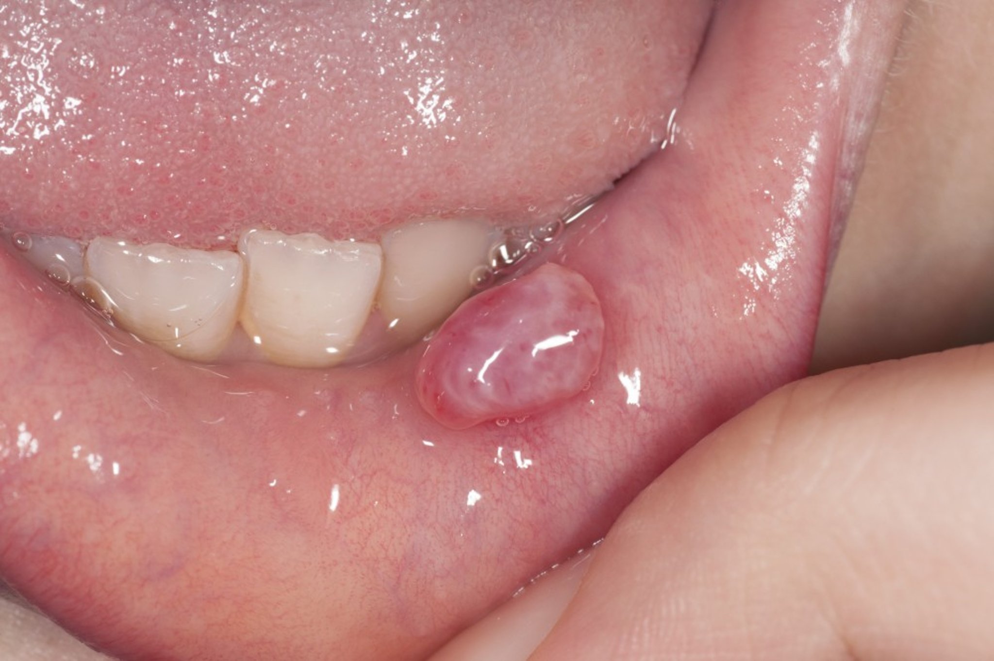 Mucus Retention Cyst (Mucocele, Mucus Extravasation Phenomenon)