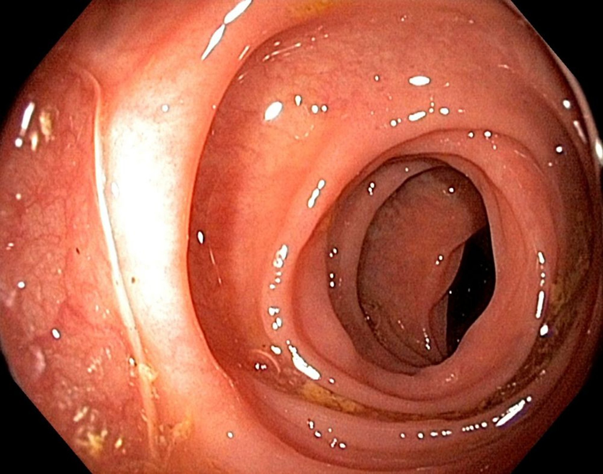 Endoscopia (intestino grosso)