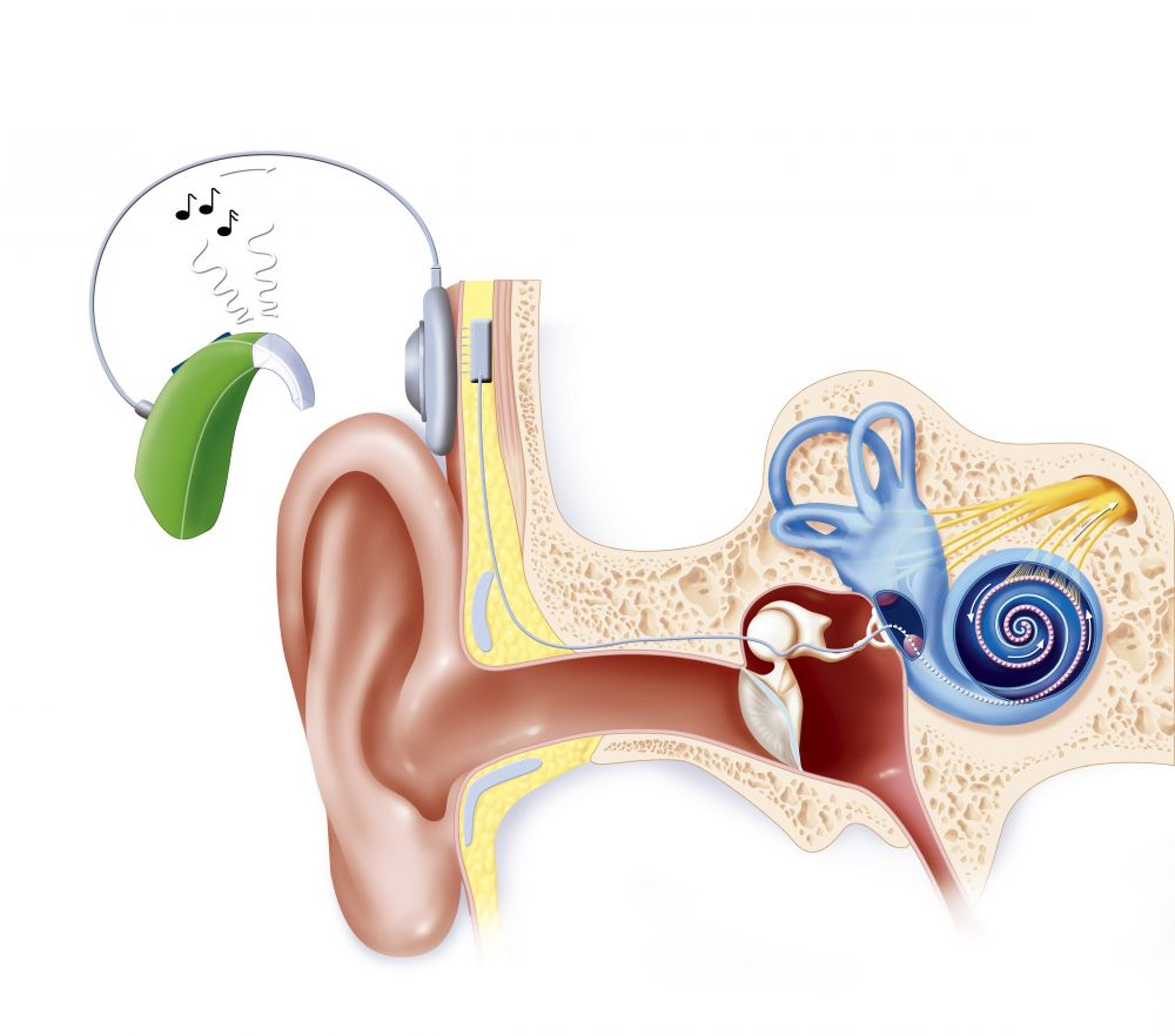 Cochlear Implant