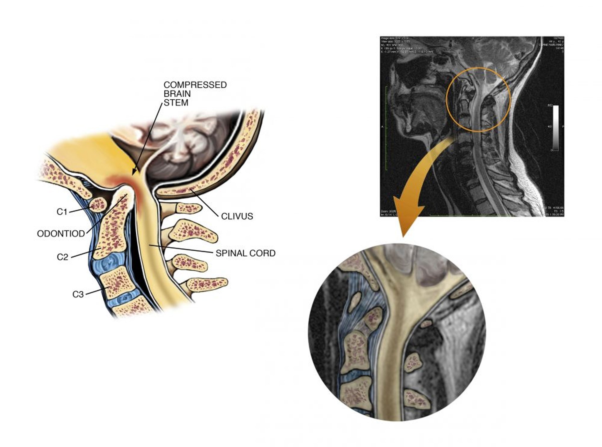 颅底凹陷症（MRI）