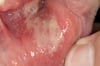 Major Aphthous Ulcer