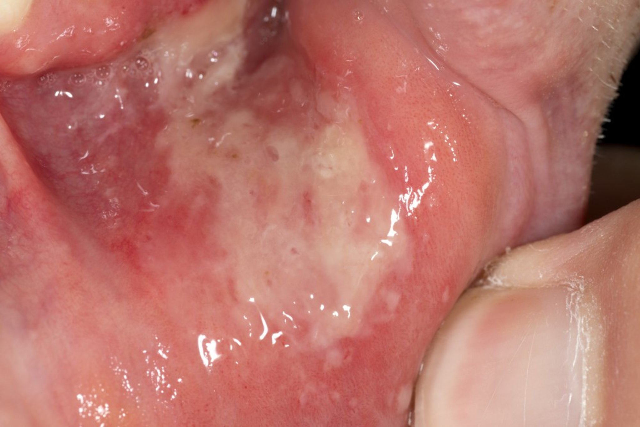 Major Aphthous Ulcer