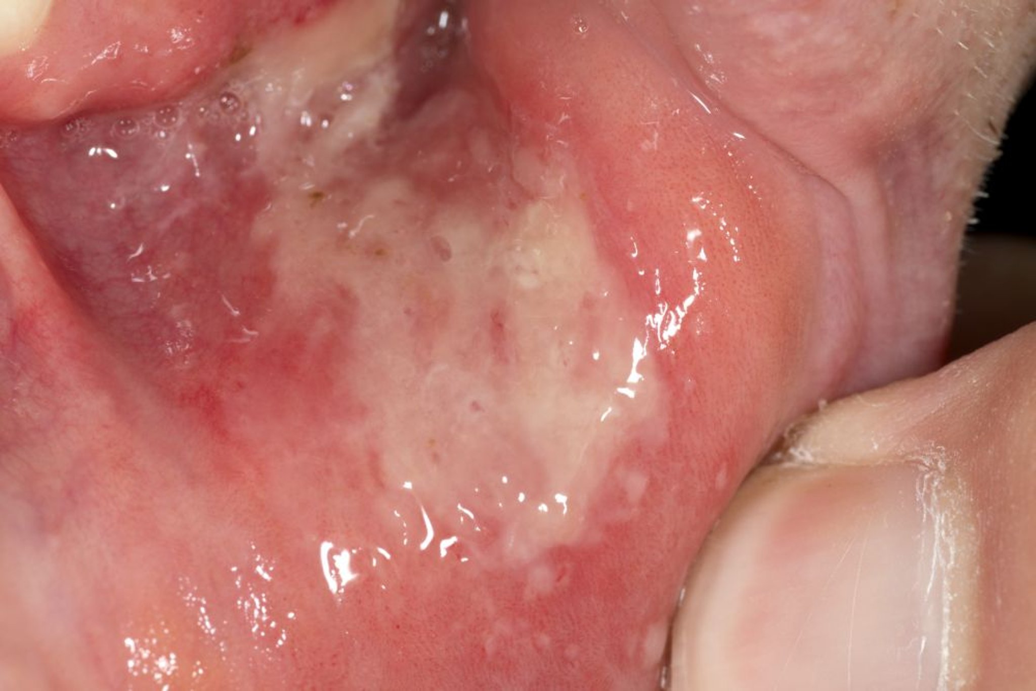 Úlcera aftosa mayor