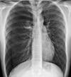 Tension Pneumothorax
