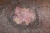 Healed Venous Stasis Ulcer