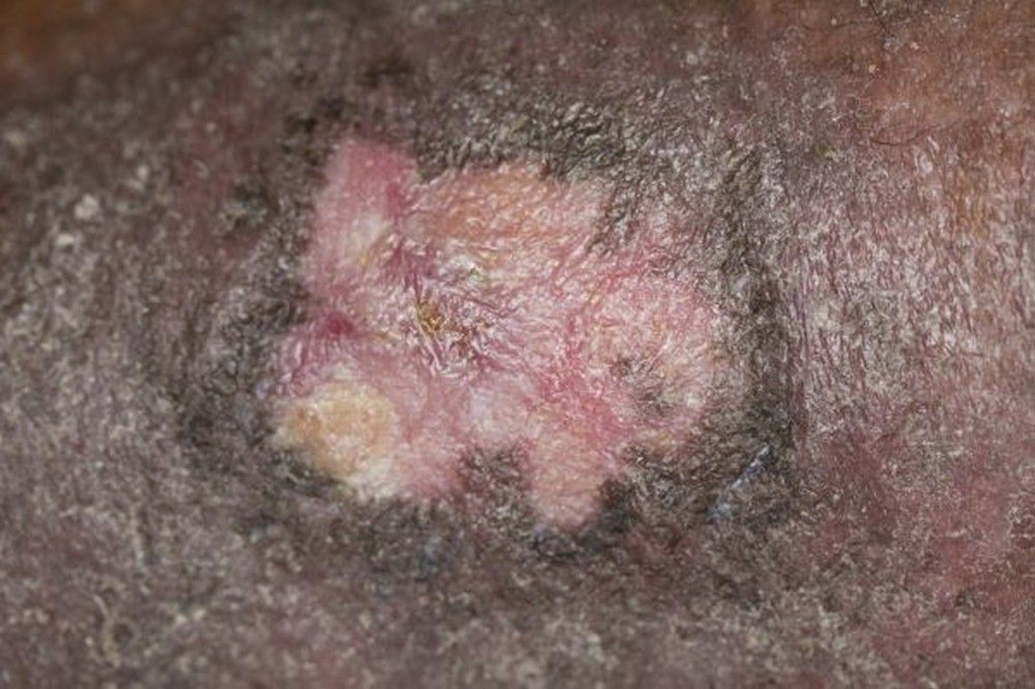 Healed Venous Stasis Ulcer