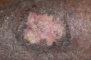 Ulcera da stasi venosa cicatrizzata