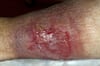 Venous Stasis Ulcer